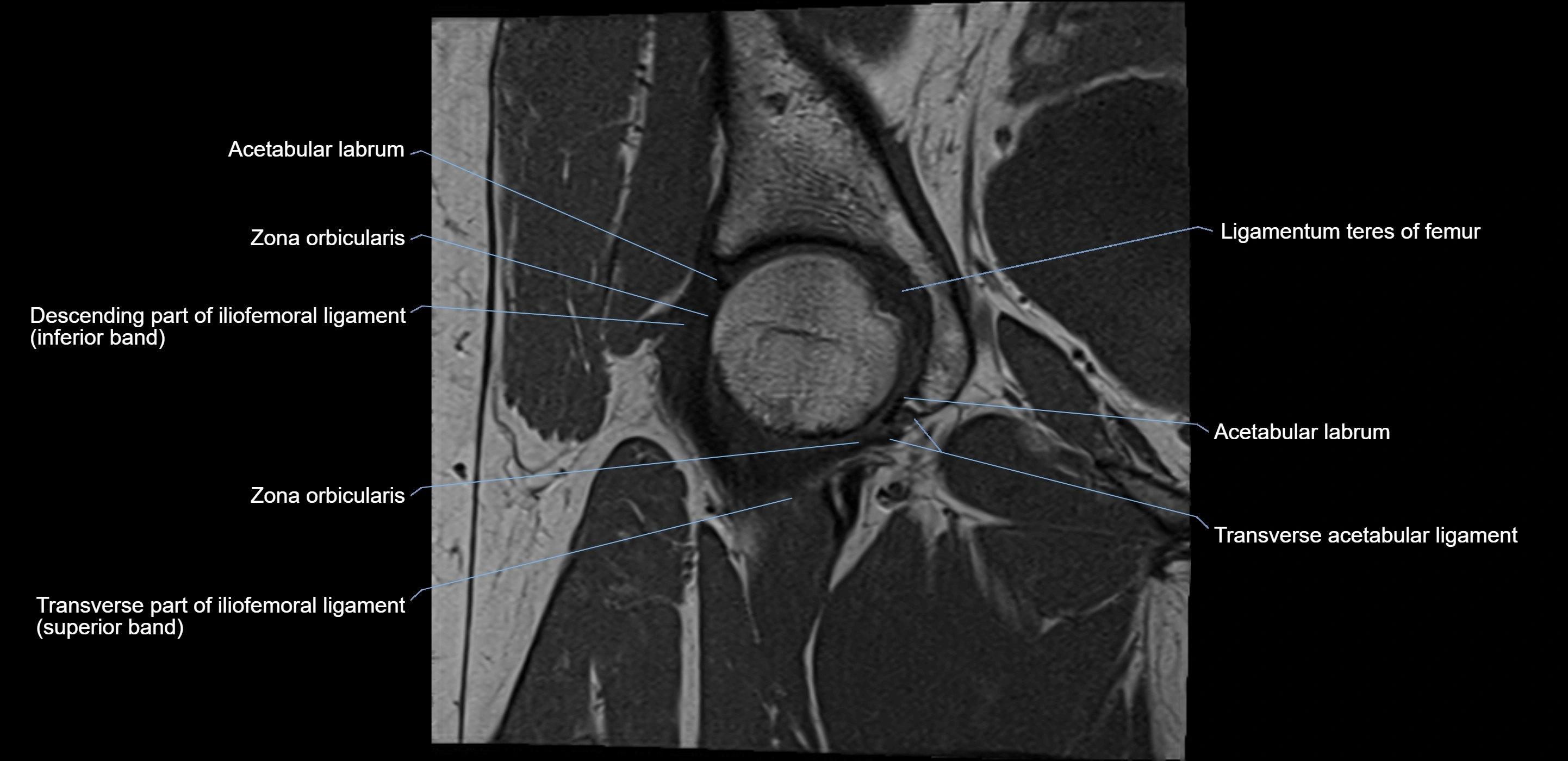 MRI Hip ligaments coronal cross sectional anatomy 3T  radiology  image-img-00001-00008.webp